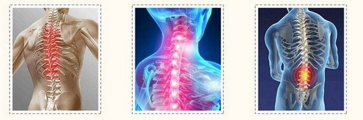 Osteocartílago de diferentes espinas