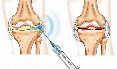 Bloqueo de la articulación de la rodilla