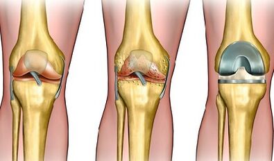 El grado de desarrollo articular de las articulaciones de la rodilla