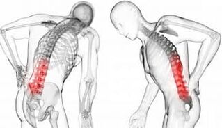 Hernia vertebral complicaciones y complicaciones de la osteocondrosis