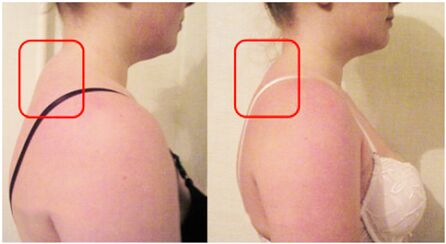 La formación de rodillos musculares y degeneración del cartílago óseo cervical