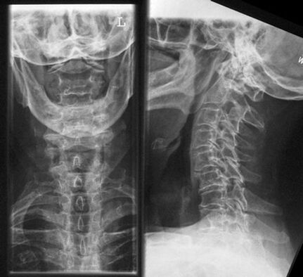 Rayos X cervical métodos de diagnóstico para la osteocondrosis