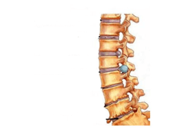 Daño a la columna con osteocondrosis cervical.
