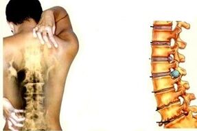 Dolor de espalda en diferentes etapas de desarrollo de la osteocondrosis cervical