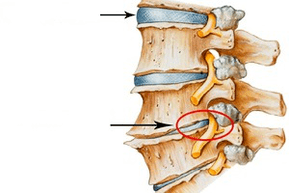 Enfermedad osteocondral de cuello espinal normal y dañado