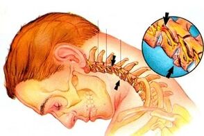 Nervios intercalados en la columna con hueso cervical y cartílago