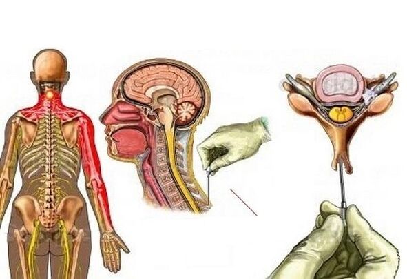 Tratamiento con acupuntura de la osteocondrosis cervical.