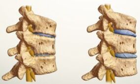 ¿Cómo se ve la osteocondrosis