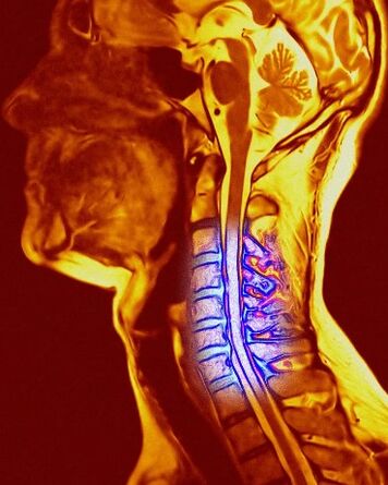 Condrosis de la columna cervical