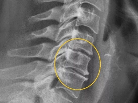Osteocondrosis cervical en radiografía